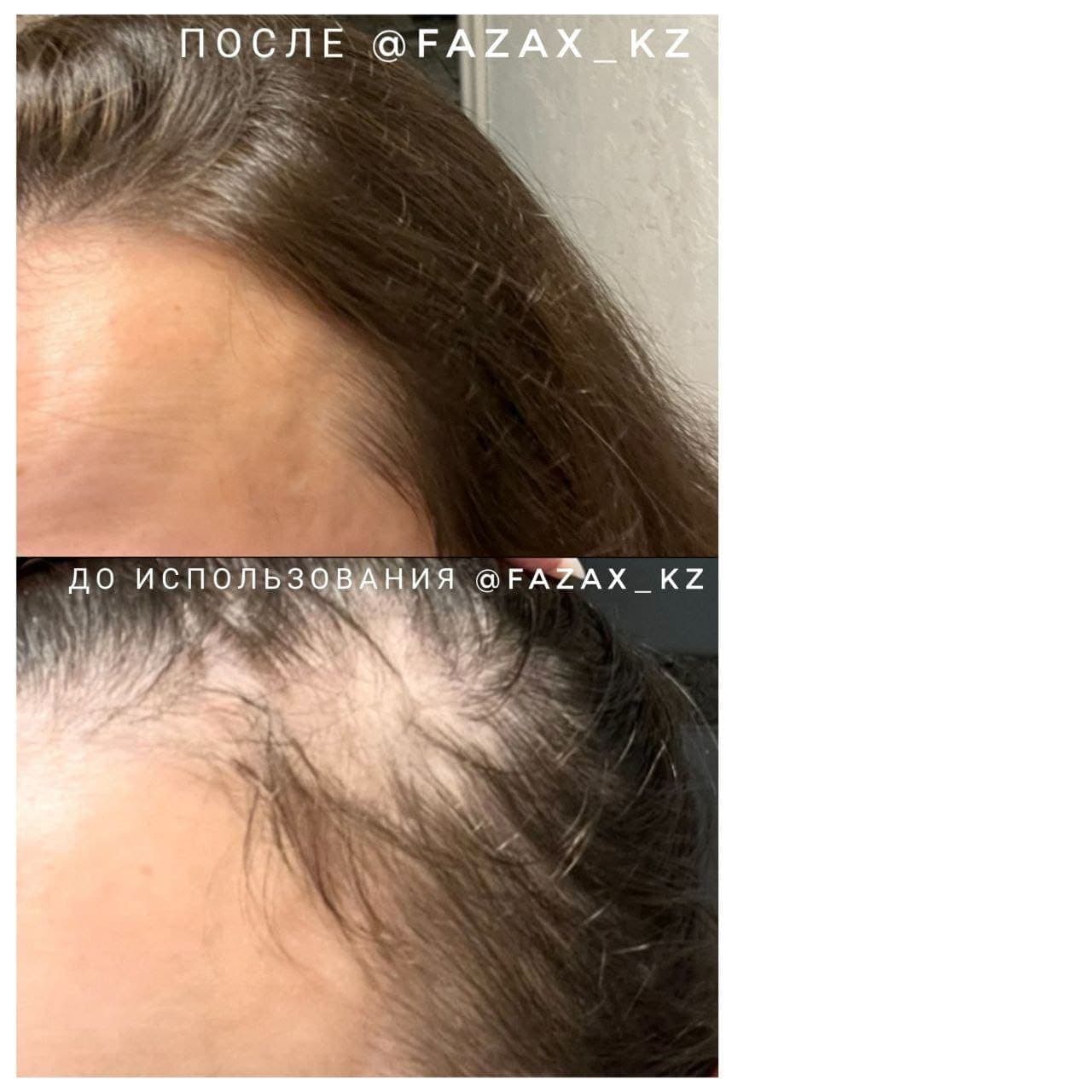 Средство для стимуляции роста волос Fazax (Depixil 15%) 4х8 мл. (на 4 мес). — фото 7